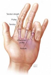 Illustration of hand with trigger finger