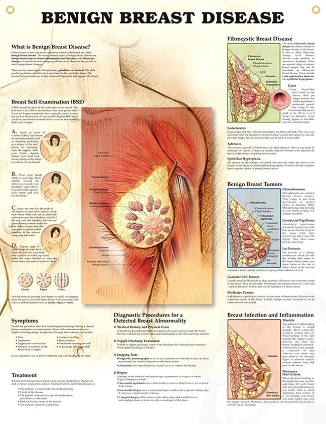Benign Breast Disease anatomy poster defines non-cancerous female breast tumor a...