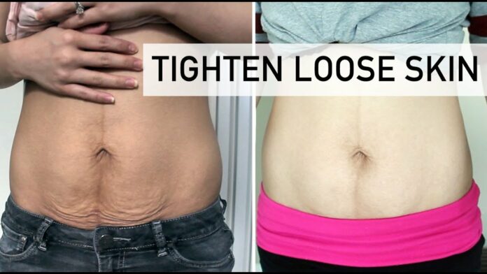 Does loose skin after weight loss go away?