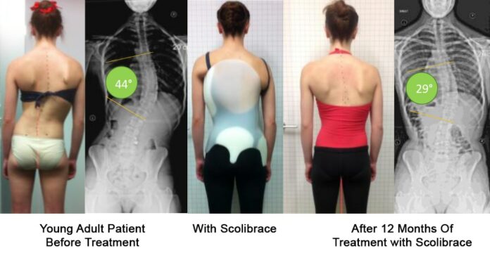 How can I fix scoliosis naturally?