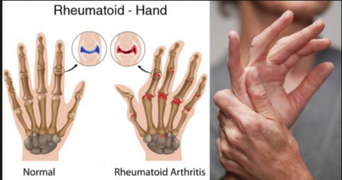 How do doctors test for arthritis?