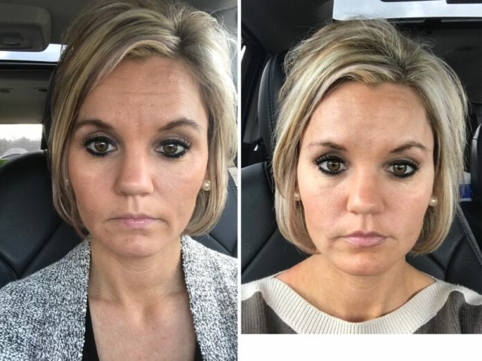 Can Botox move after 2 days?