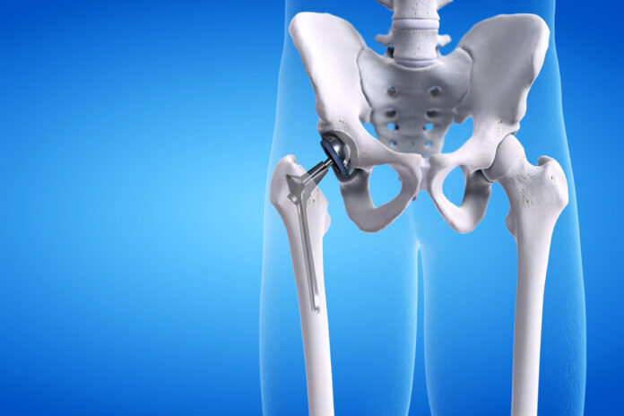 Can you ever bend past 90 degrees after hip replacement?
