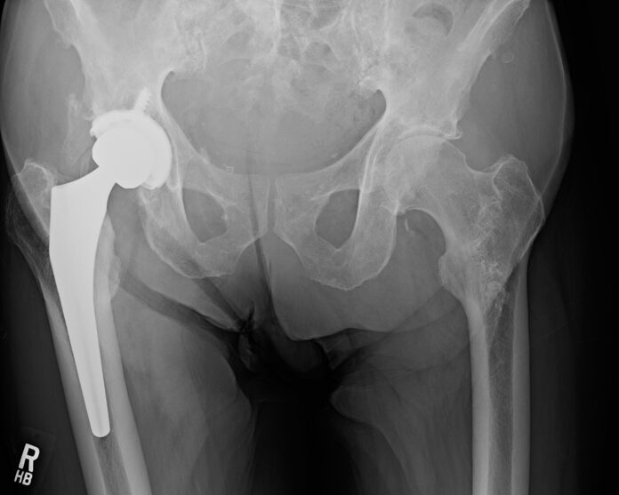 What happens if you overdo it after hip replacement?