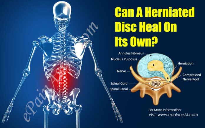 Why is my herniated disc not healing?