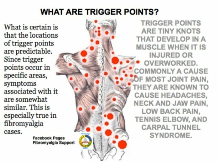 What are the 18 trigger points for fibromyalgia?