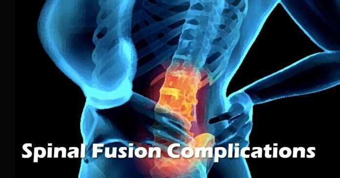 Are there any permanent restrictions after spinal fusion?
