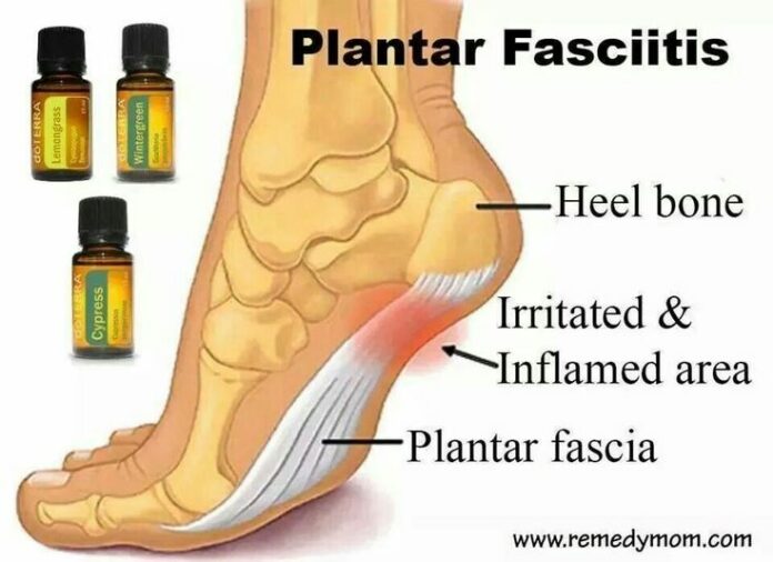 Should I walk barefoot with plantar fasciitis?
