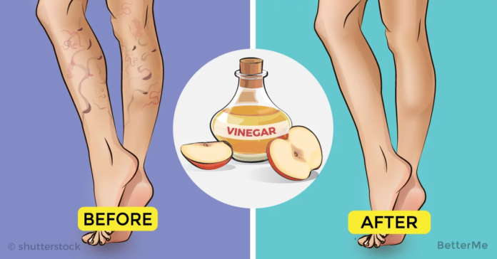 What is the root cause of varicose veins?