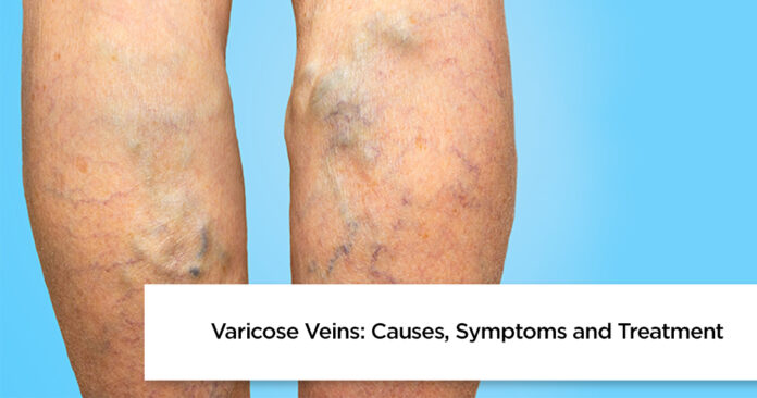Why am I suddenly getting varicose veins?