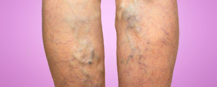 What to drink to cure varicose veins?
