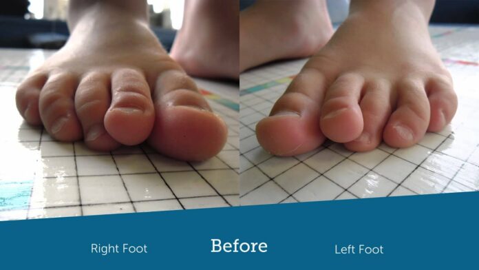 Why do toes curl with age?