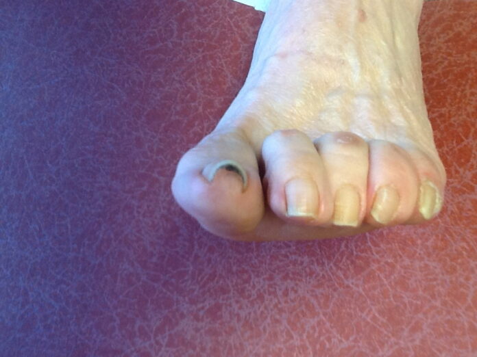 Can you straighten curled toes?