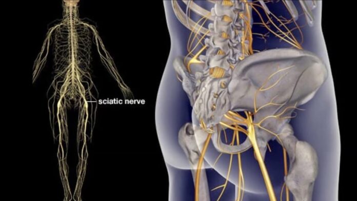 What does chiropractor do for sciatica?