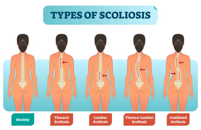 Can vitamin D stop scoliosis?