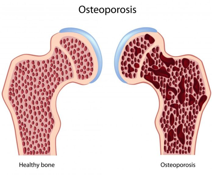 How does osteoporosis affect the lungs?