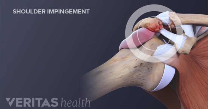 How do you fix impingement syndrome?
