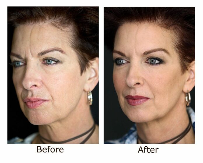 How long does Botox take to settle?