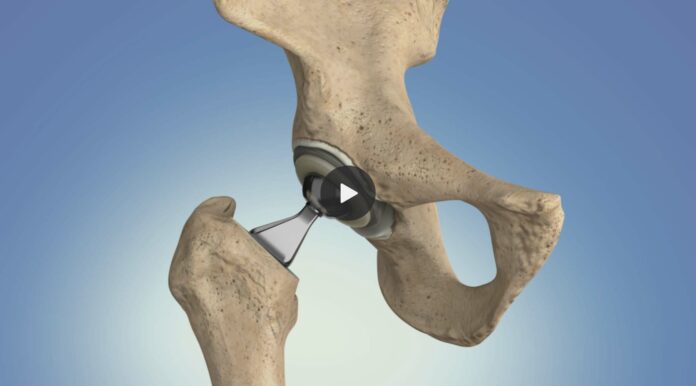 How long does it take for the muscles to heal after a hip replacement?