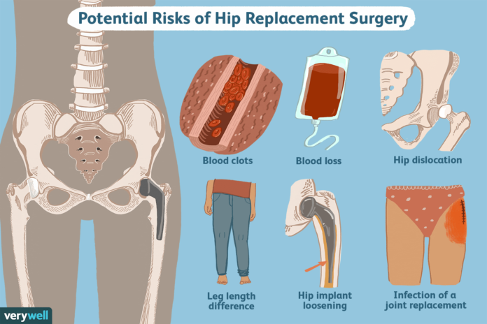How do I know if I damaged my hip replacement?