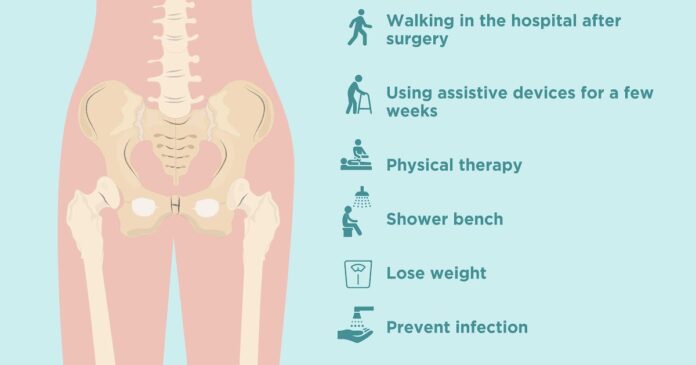 Can you lift weights after hip replacement?