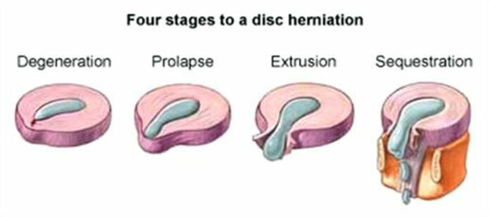 How long does it take for a severe herniated disc to heal?