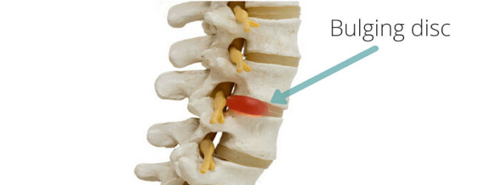 Can a chiropractor fix a bulging disc?