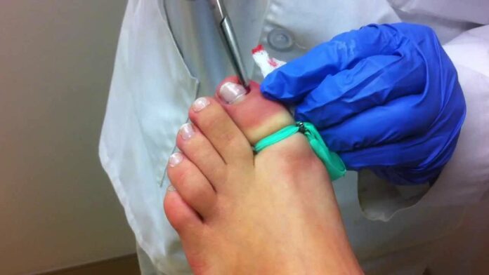 What disease makes your toes curl?
