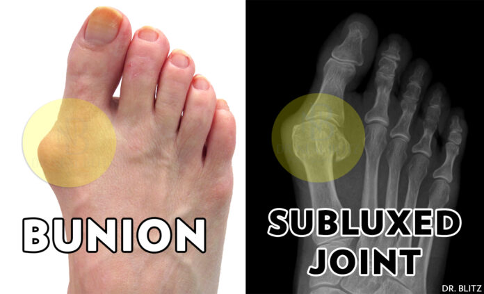 Can you push a bunion back in?