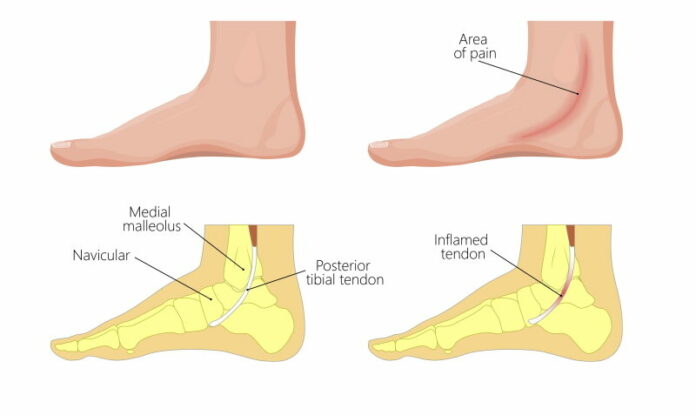 Is walking barefoot good for flat feet?
