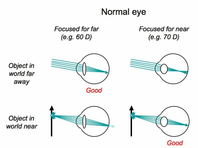 How can I reduce the cylindrical power in my eye?