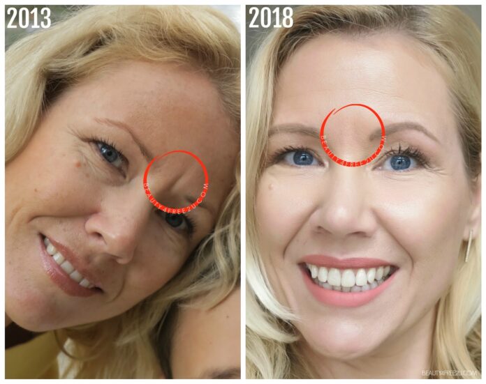 How long keep head up after Botox?