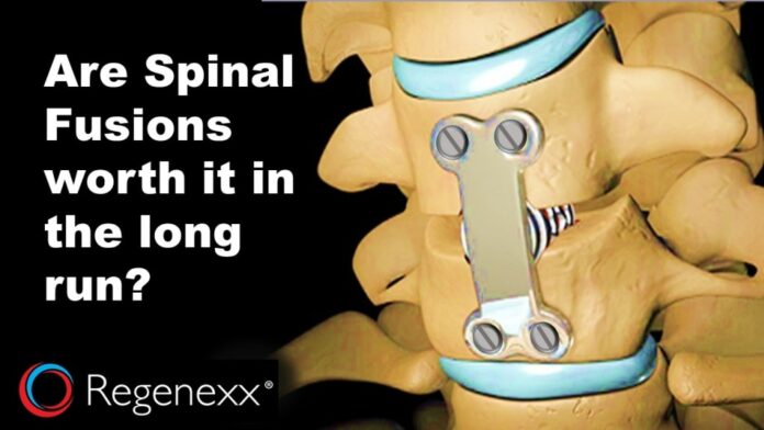 Why does my back still hurt years after spinal fusion?