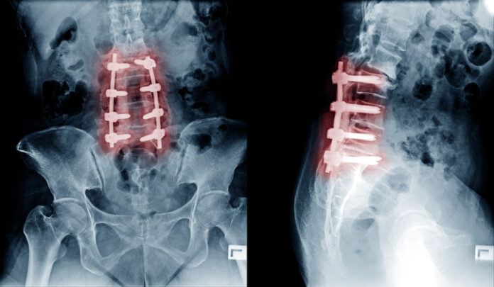 How long do spinal fusions last?