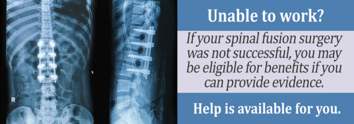 Can you ever bend again after spinal fusion?